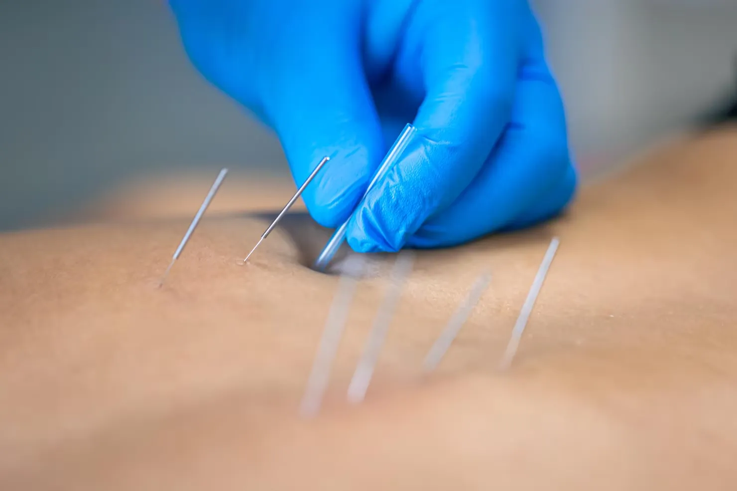 Dry Needling in Jacksonville, IL